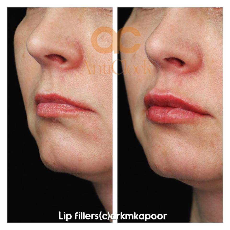 lip fillers before and after picture