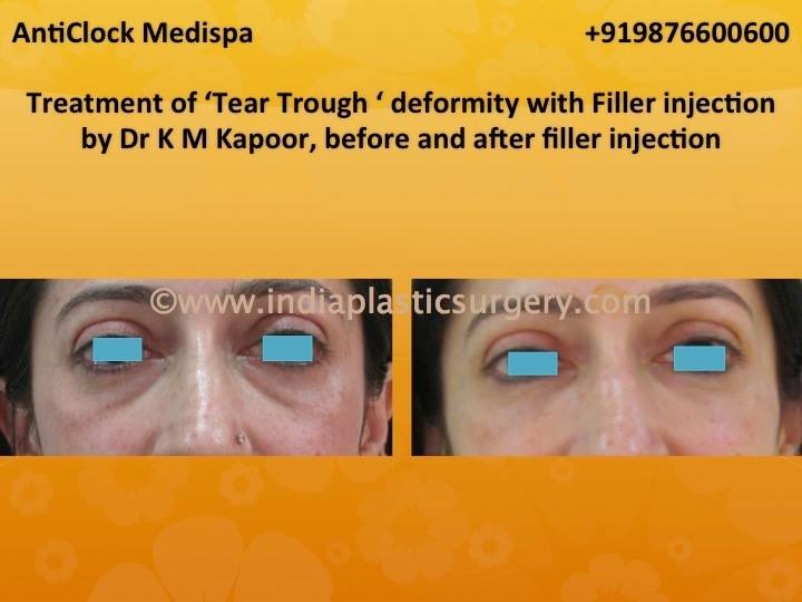 tear trough treatment before and after