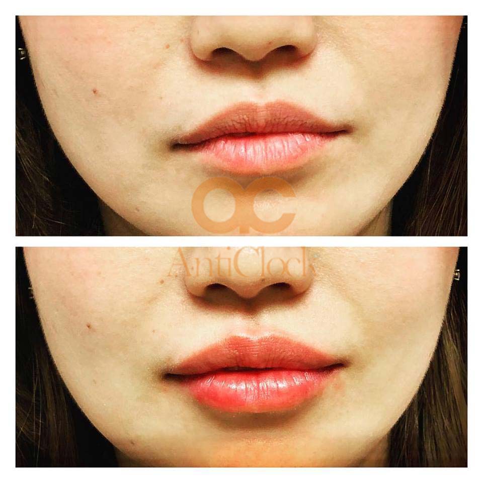 lip fillers before and after 
