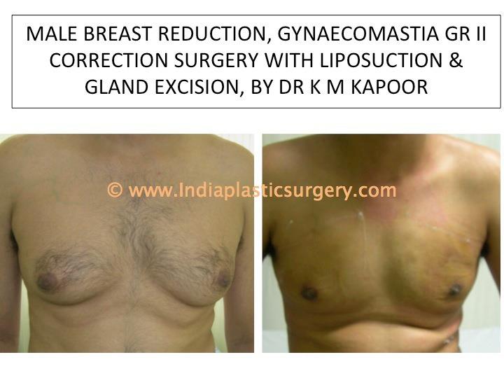 gynecomastia surgery before and after India