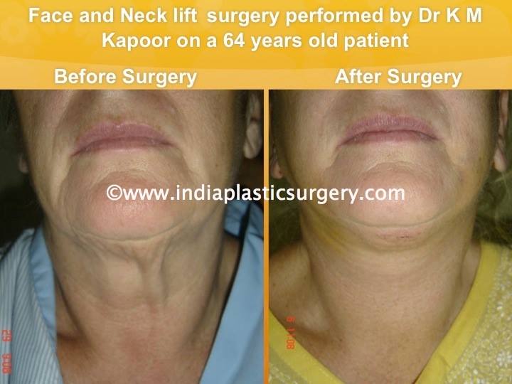 face and neck lift before and after