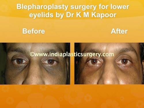 blepharoplasty- eye surgery before and after
