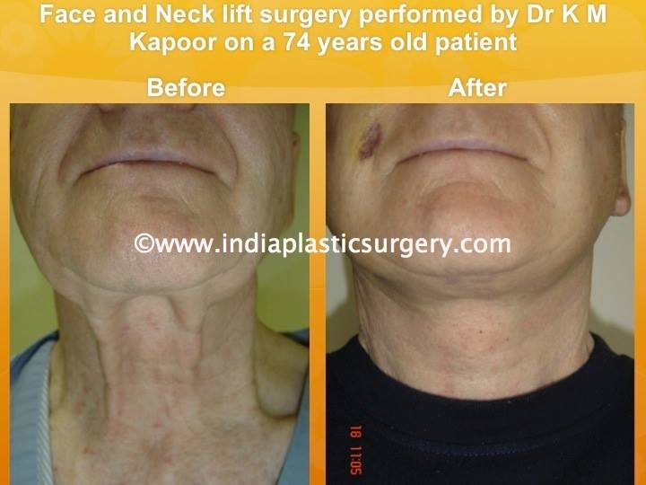 face and neck lift before and after