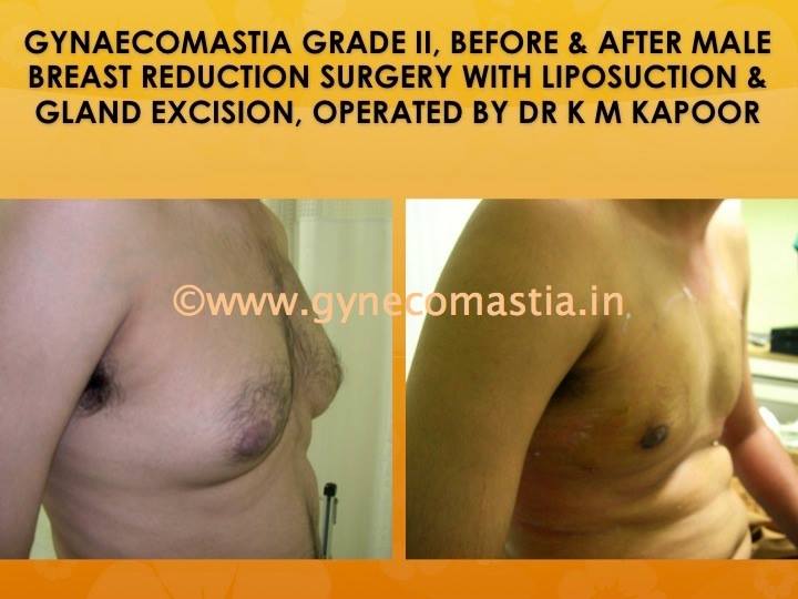male breast- gynecomastia surgery before and after