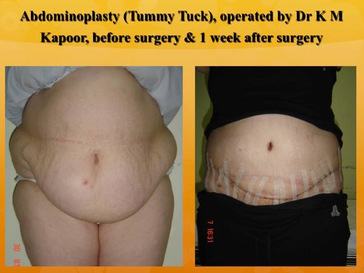 Abdominoplasty-Tummy Tuck before and after