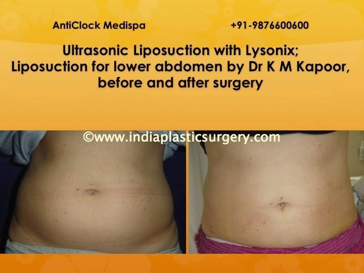 liposuction surgery before and after