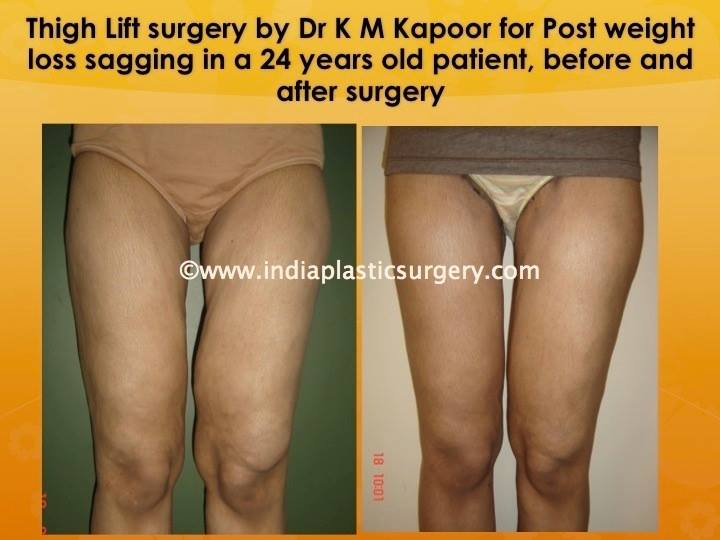 Thigh-Lift treatment before and after