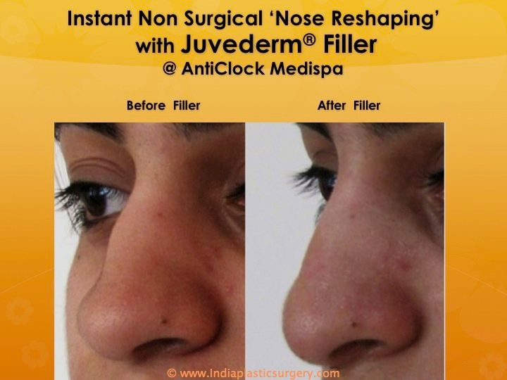 rhinoplasty- nose surgery before and after 