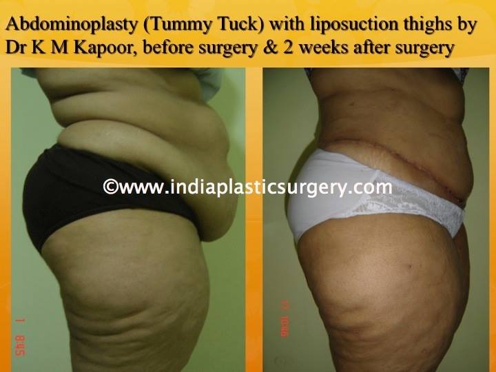 Abdominoplasty-Tummy Tuck Surgery Before and After