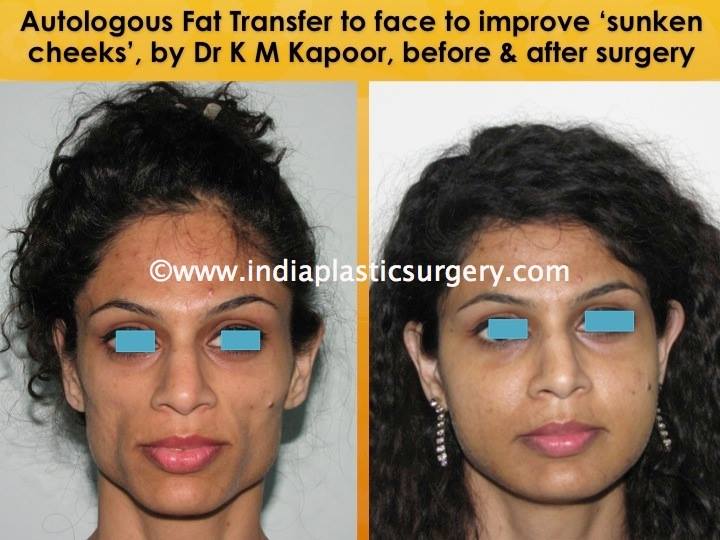 fat transfer to face before and after