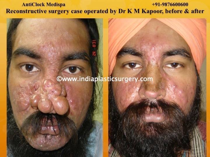 reconstructive surgery before and after