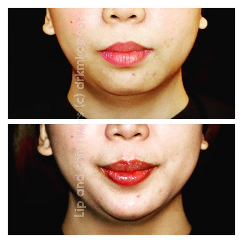 lip fillers before and after 
