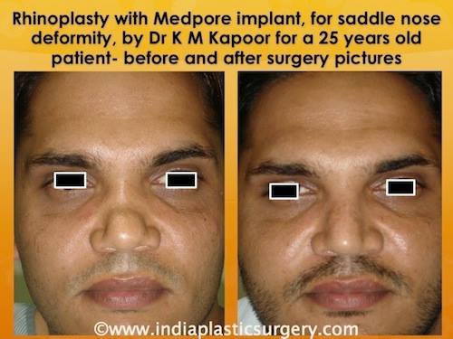 rhinoplasty- nose surgery before and after 
