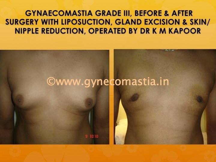 male breast- gynecomastia surgery before and after India
