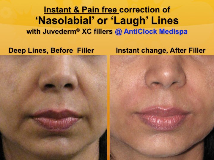 nasolabial fold treatment before after
