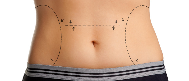 Post Pregnancy Labiaplasty